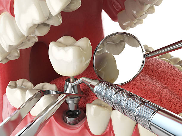 Best Emergency Broken Tooth Repair in Celebration, FL