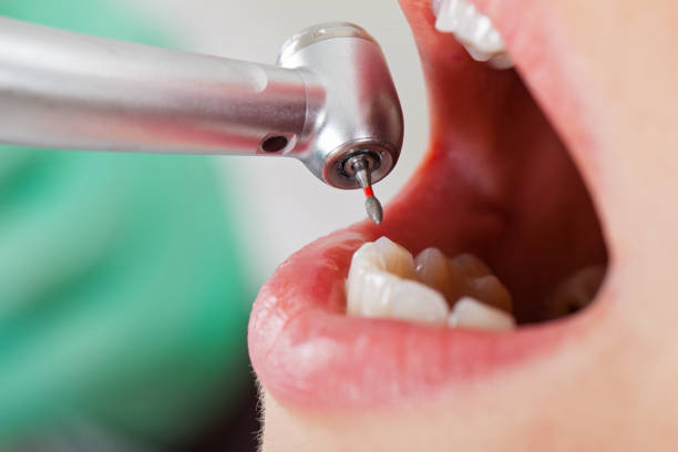 Best Emergency Tooth Extraction in Celebration, FL